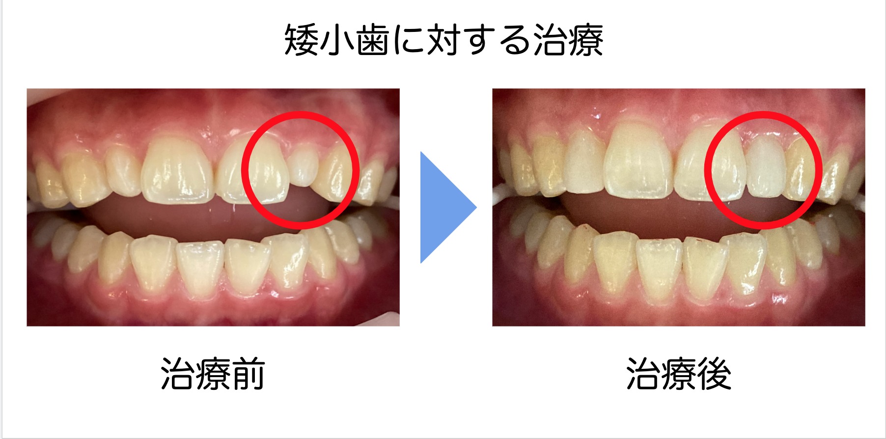 小ぶりな歯 矮小歯 もきれいな形にできるグラディアダイレクト 更新日 21年10月2日 野原歯科医院 鵜の木駅と下丸子駅の間にある歯医者 歯科